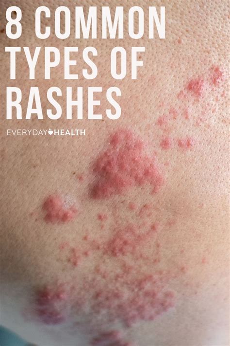 Skin Rash Fungal Infections Fungus Mayra Flores