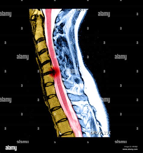 Mri Of A Cervical Herniated Disc Hi Res Stock Photography And Images