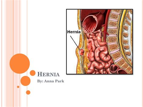 Ppt Hernia Powerpoint Presentation Free Download Id2659430