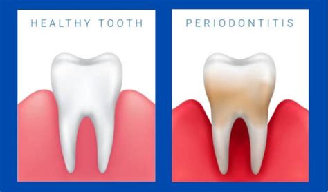 What Happens When Periodontal Disease Goes Untreated D Dental