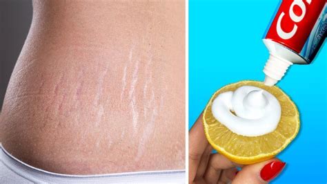 How To Reduce Stretch Marks Diy Home Remedies 5 Minutes Beauty Tips