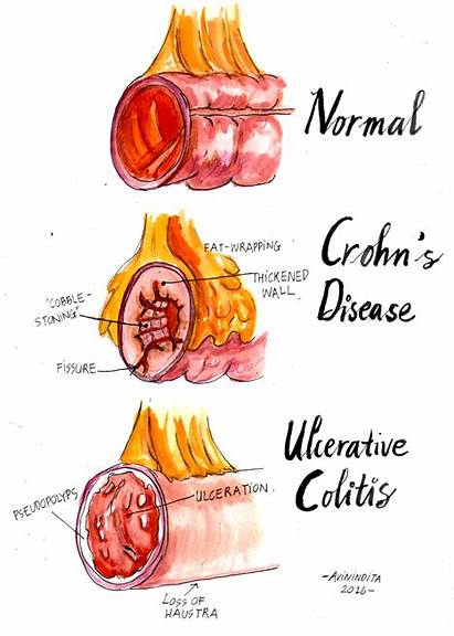 Colitis Ulcerative Stool Inflammatory Disease Bowel Crohns