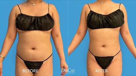 How Much Does Liposuction Cost Liposuction Pricing