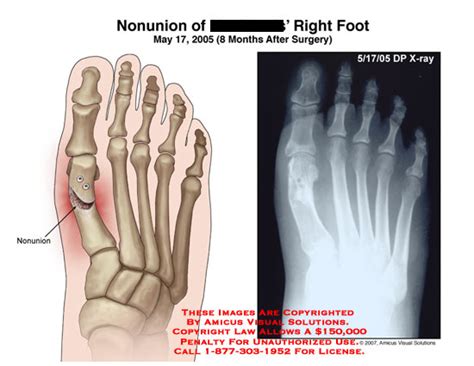 Amicus Illustration Of Amicusradiologyinjuryfirst1stmetatarsalx