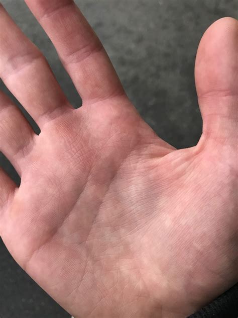 Warum habe ich weiße Flecken auf der Hand? (Computer, Gesundheit und