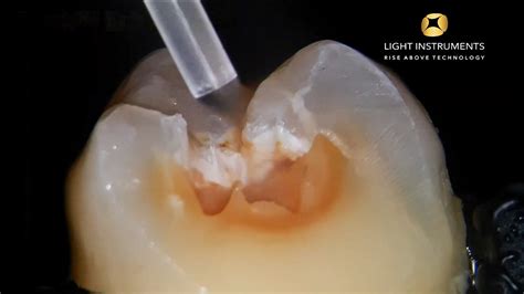 Restorative Dentistry With The Litetouch™ Eryag Light Instruments Ltd