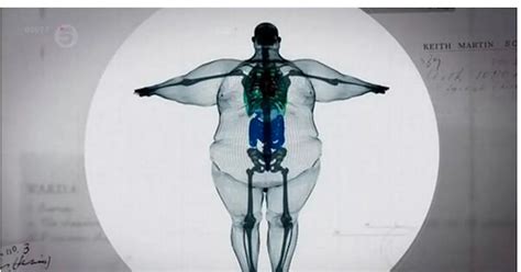 Shocking Mri Scan Picture Of 64 Stone Man Will Put You Off Unhealthy