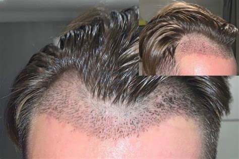 What You Need To Know About Shedding After A Hair Transplant