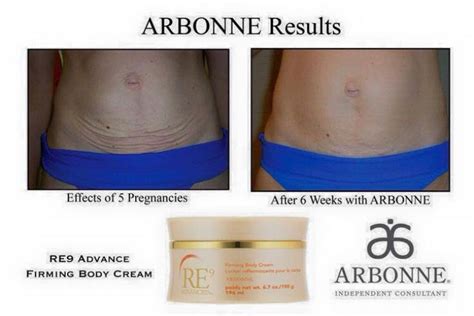 Botox injectons are mainly used by celebrities to get rid of wrinkles and other aging signs. Results after 6 weeks using the Arbonne firming body cream ...