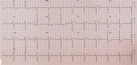 Enciclopédia De Ecg Ecg De A A Z Flutter Auricular