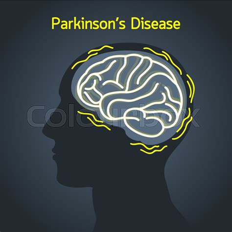 Neurodegeneration and neuroprotection in parkinson's disease. Parkinson's disease vector logo icon ... | Stock vector | Colourbox