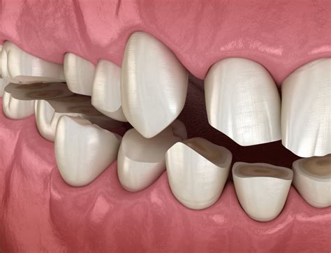 Enamel Wear In Ripon Bruxism Silver Creek Dentistry