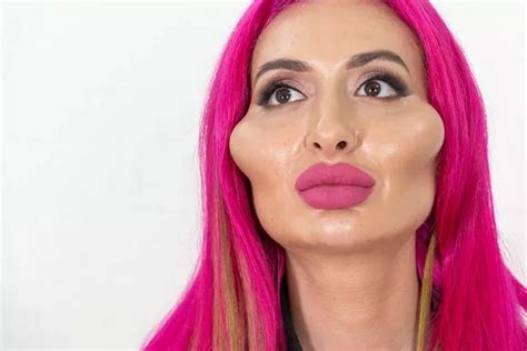 Model With Worlds Biggest Cheeks Shows What She Looked Like Before Extreme Filler Daily Star