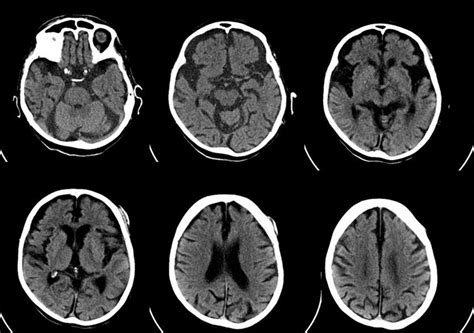 Brain Computed Tomography Scan Showing Moderately Severe Atrophy In
