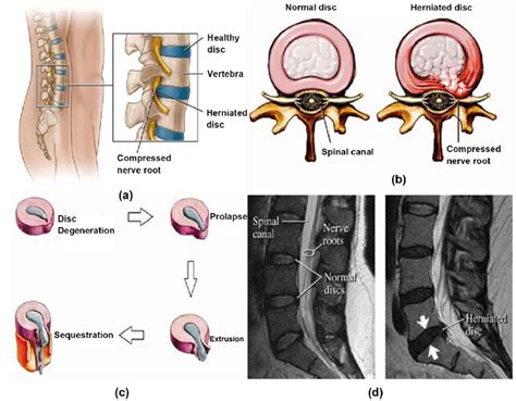 Lumbar Disc Herniation A Showing Herniated Disc At L L Level