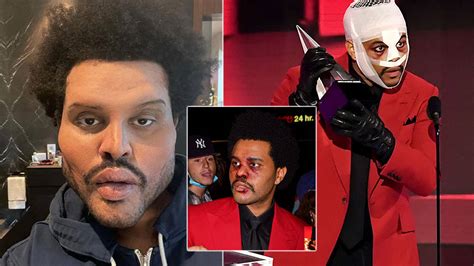 What Happened To The Weeknds Face His Bandages Botox And Plastic