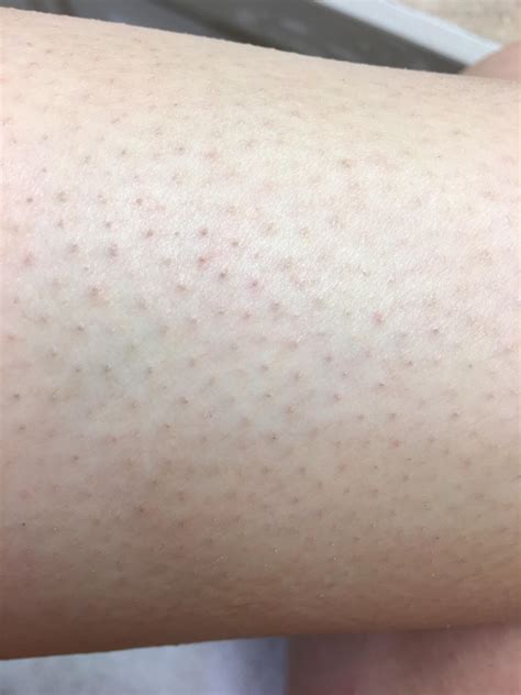Epilator before and after legs.