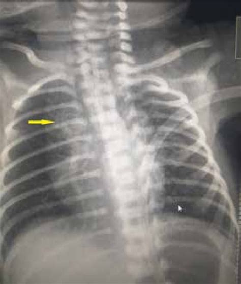 Chest X Ray Ap View Of A Neonate Prominent Vascular Markings Are Seen Download Scientific