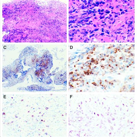 Pdf Methotrexate Induced Lymphoproliferative Disease Epstein Barr