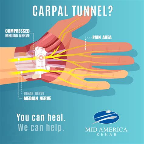 The Amazing Benefits Of Physical Therapy For Carpal Tunnel Syndrome Mid America Rehab
