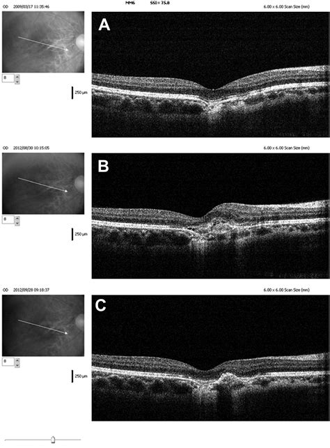 Focal Choroidal Excavation Complicated By Choroidal Neovascularization