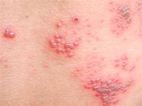 Dermatitis Herpetiformis Blisters