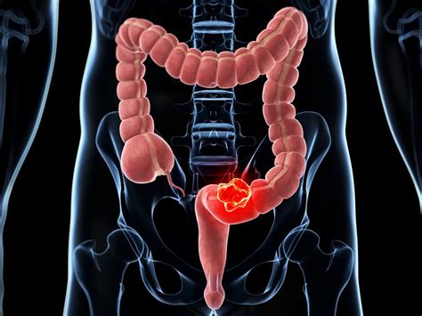 Colorectal Cancers On The Rise In Younger Adults