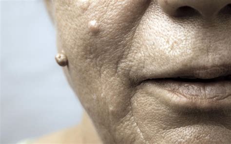 Papilloma On Face Treatment Hpv On Face Treatment Warts On Skin