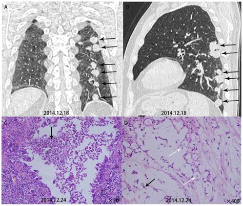 Comparative Study Of Primary Pulmonary Cryptococcosis With Multiple