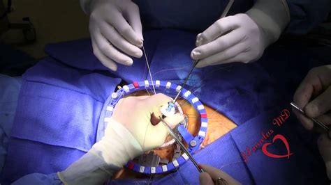 Valve Replacement Youtube Aortic Valve Replacement Surgery