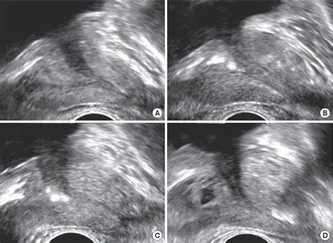 Figure 1 From Clinical Significance Of Periurethral Calcification