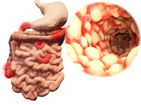 Crohns Disease Ulcerative Colitis Progression And Development Linked