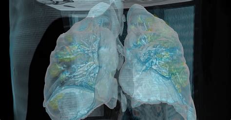 This Is What Your Lungs Look Like With Covid 19