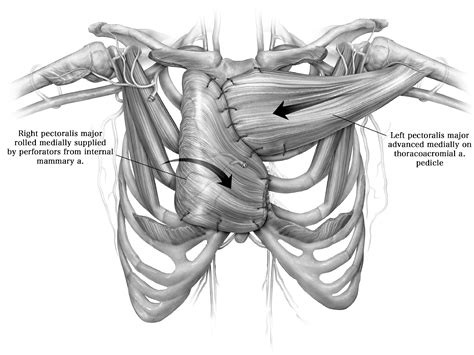 Pectoralis Muscle Flaps For Mediastinal Reconstruction Operative