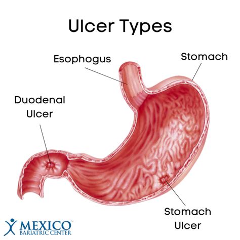 Signs And Symptoms Of Ulcers After Gastric Bypass Mexico Bariatric Center