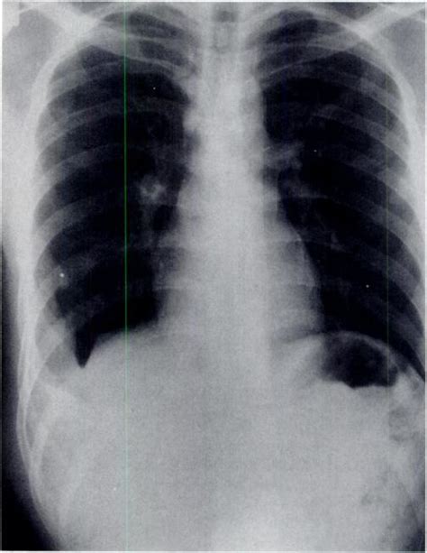 Case 1 Tuberculous Empyema Necessitatis A Chest Radiograph Shows An