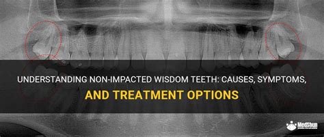 Understanding Non Impacted Wisdom Teeth Causes Symptoms And
