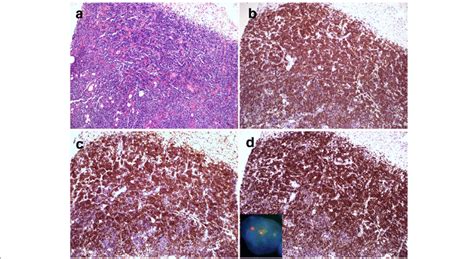 Recurrent Low Grade Follicular Lymphoma A Needle Core Biopsy Reveals