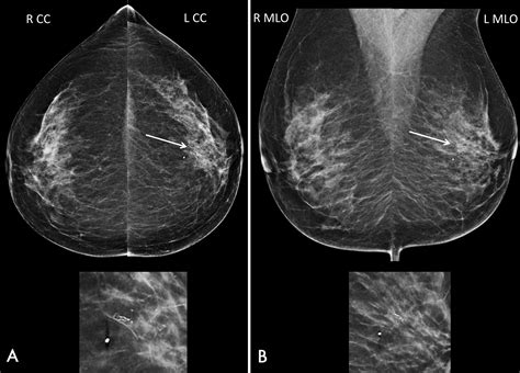 Recall And Outcome Of Screen Detected Microcalcifications During Decades Of Mammography