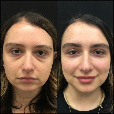 patient 141228577 lower blepharoplasty before and after photos flora levin md