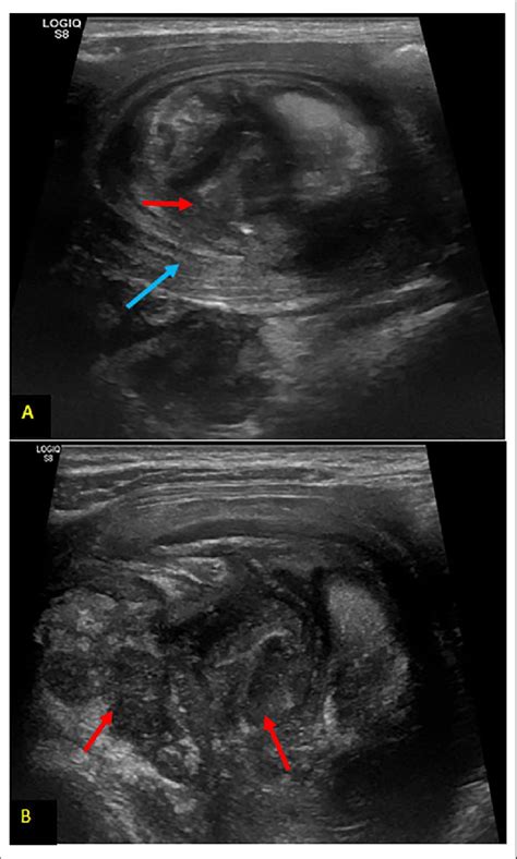 Ultrasound Images A B Showing An Epigastric Mass Of 4x6cm With