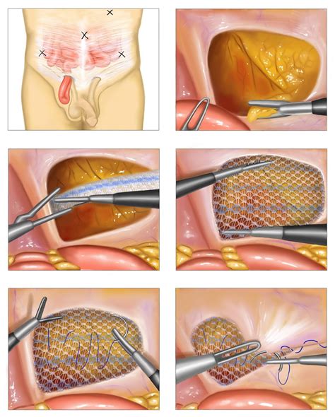 Inguinal Hernia Repair With Mesh Cpt Code Libby Othilia