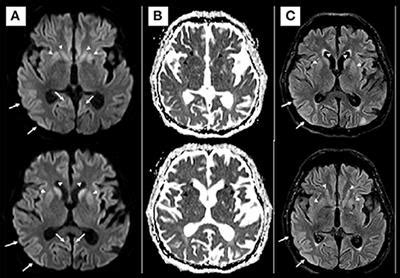 Frontiers Case Report Neurodegenerative Diseases After Severe Acute Respiratory Syndrome