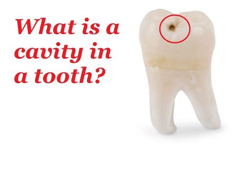 What Is A Cavity In A Tooth A Cavity Is A Hole That Can Grow Bigger