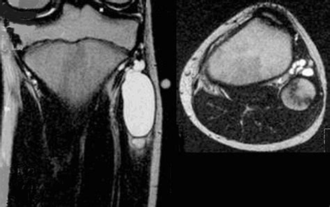 An Unusual Cause Of Paralysis Of The Peroneal Nerve—a Case Report