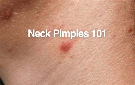 Getting Rid Of Neck Pimples How To Prevent And Treat Frontman