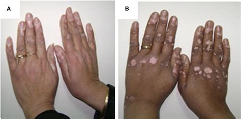 Frontiers Neural And Endocrinal Pathobiochemistry Of Vitiligo