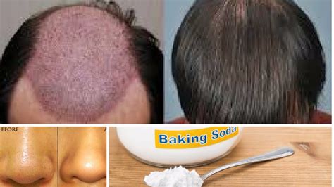 11 Benefits Of Baking Soda For Hair Skin And Body Youtube