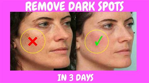 Home Remedies For Dark Spots On Face How To Remove Dark Spots From