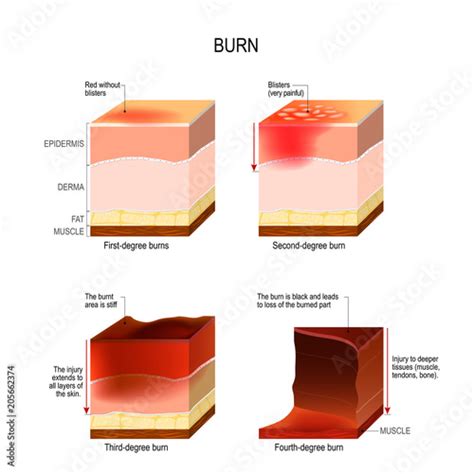 Skin Burn Four Degrees Of Burns Stock Image And Royalty Free Vector